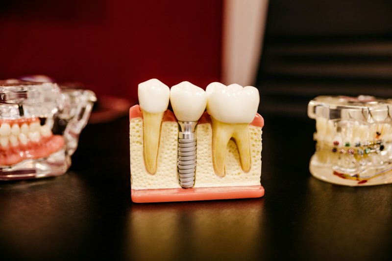 Dental Implant Specialists in Bakersfield, California